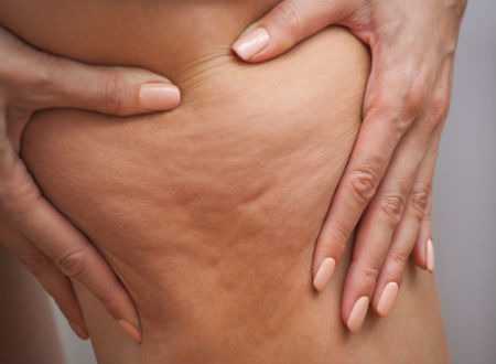 Can weight loss help in getting rid of cellulite?