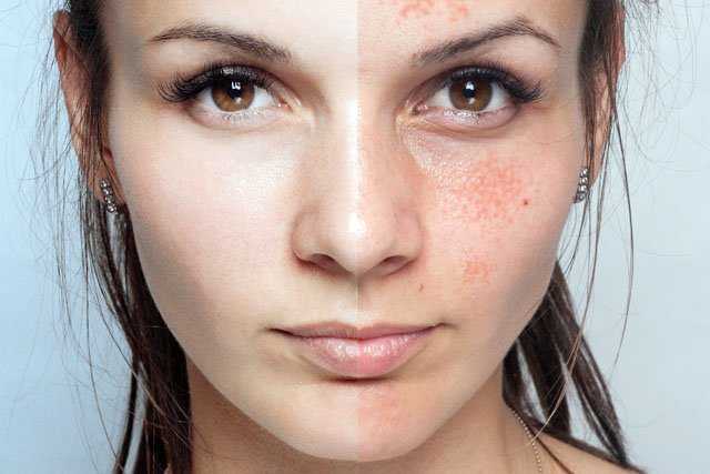 Help does pimples soda baking Dermatologist Tells