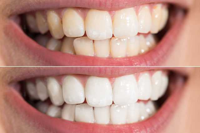 3 hydrogen peroxide to whiten teeth