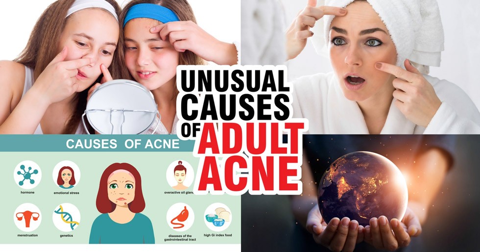 Unusual Causes Of Adult Acne 4428