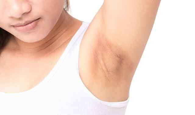 Express Hack To Get Rid Of Dark Underarms Femina In get rid of dark underarms