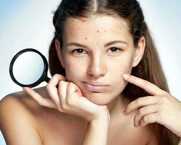 How To Remove Pimple Marks Effective Ways Femina In remove pimple marks effective ways