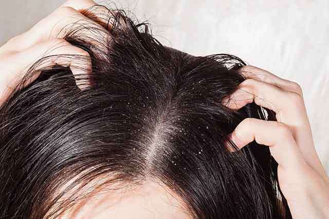Olive Oil Keeps Your Hair Dandruff Free