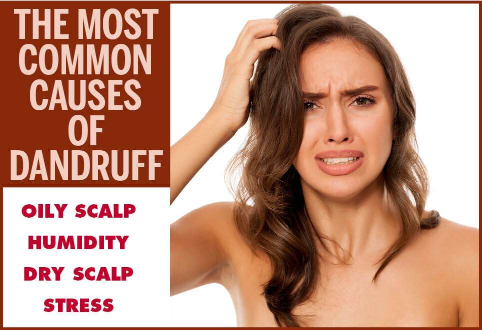Main Causes Of Dandruff & How To Avoid Them 