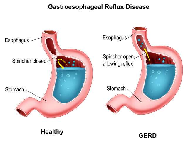 What causes GERD