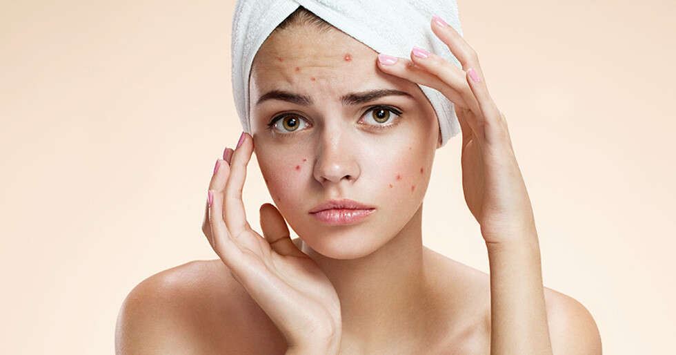 How To Treat Acne At Home | Femina.in