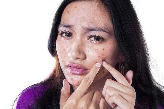 Remove Spots From Face Due To Acne