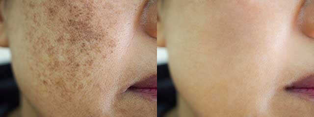 Spots Due To Melasma