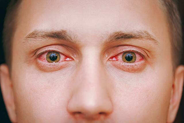 how-to-deal-with-watery-eyes-femina-in