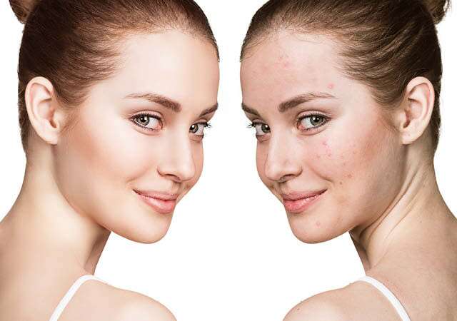 Is Apple Cider Vinegar A Good Choice For Sensitive Skin As Natural Facial Cleansers