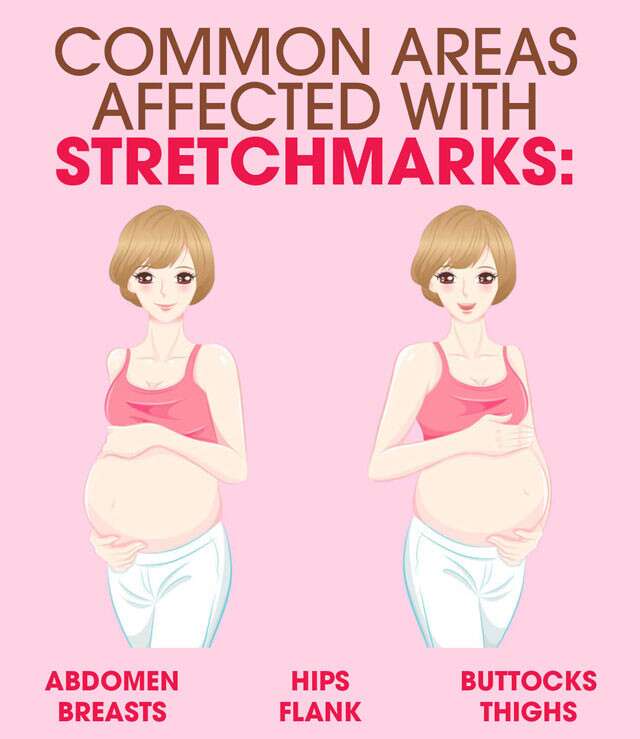 Pregnancy Stretch Marks: Prevention & Treatment