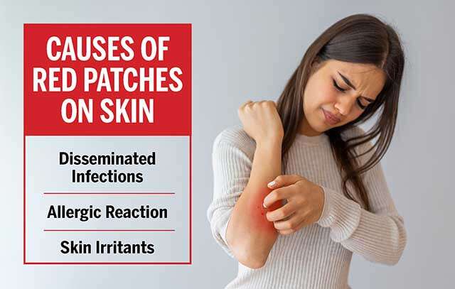 Causes of Red Patches On Skin Infographic