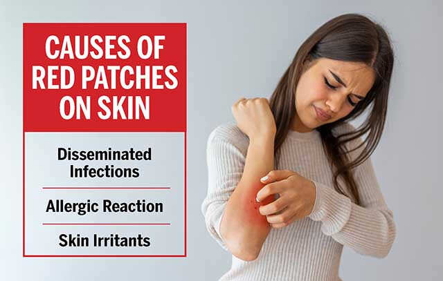 How To Deal With Red Patches On Skin