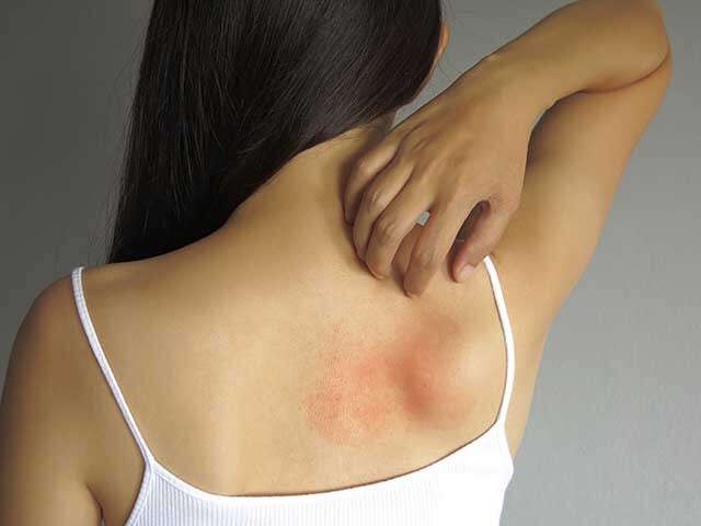 Red patches on the skin can be a temporary
