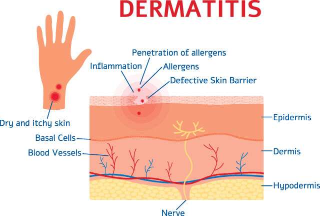 Various Types of Dermatitis Skin Infographic