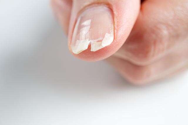 Aggregate more than 74 finger nails breaking super hot