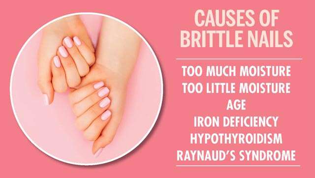 Brittle Nails: Causes, Symptoms, Treatment and Home Remedies 