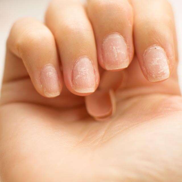 Brittle Nails: Causes, Symptoms, Treatment and Home Remedies 