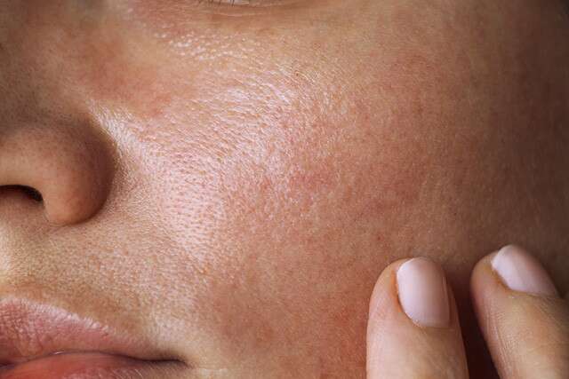 What Causes Combination Skin?