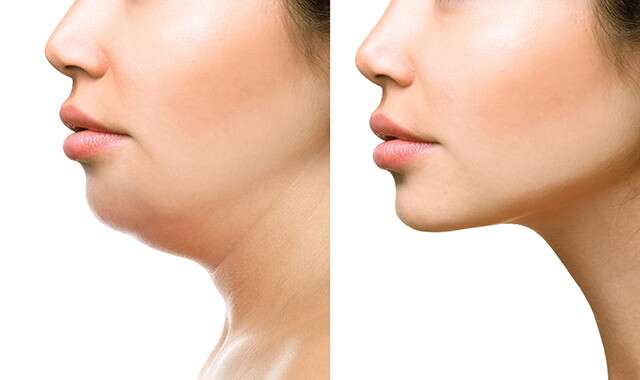 Facial Exercises Can Reduce The Appearance Of Double Chin