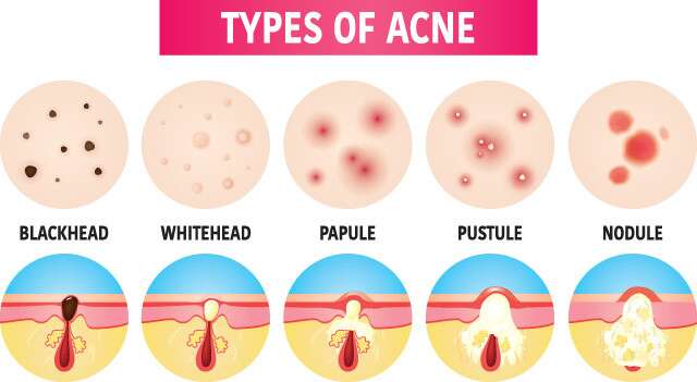 Everything About Acne-Prone Skin: Types, Causes & Remedies | Femina.in