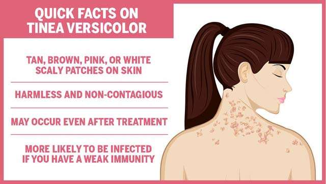 Fakta tentang Tinea Versicolor Infographic