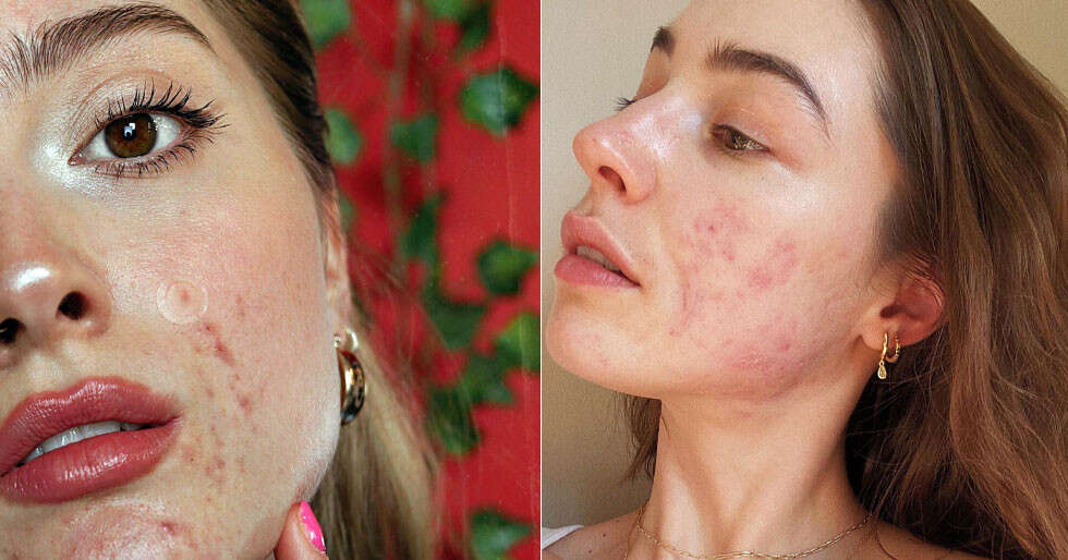 5 Skin-Positive Influencers Aiming To Bring Change In Beauty Community - Vimarsana News