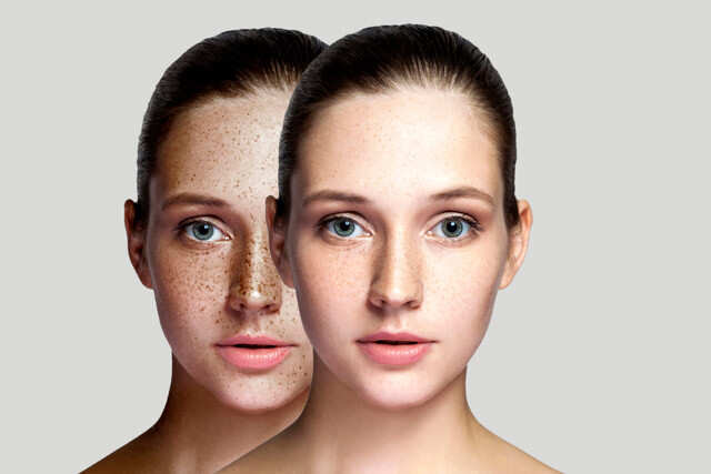 Get Rid Of Marks On Face Quickly With This Guide! | Femina.in