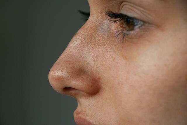 Here’s Why You Commonly Find Blackheads On Nose