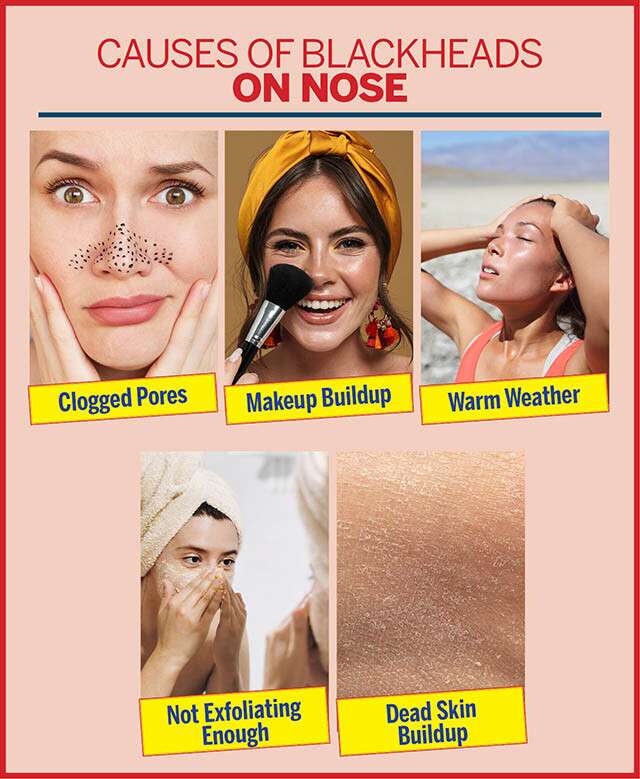 The Causes of Blackheads Infographic
