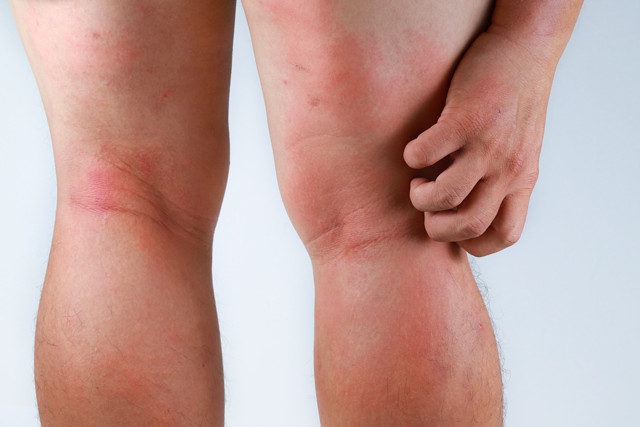 Eczema is one of the cause of red spots and bumps on legs.
