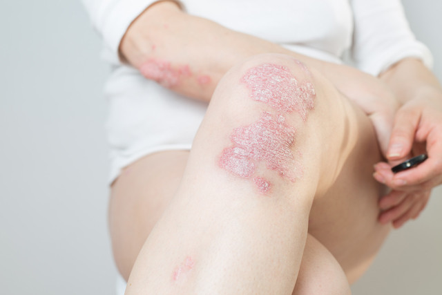 Psoriasis is one of the cause of red spots and bumps on legs.