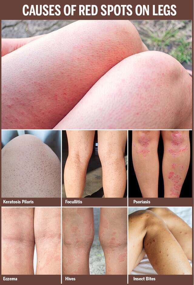 Red Spots on Legs: Causes, Small, Itchy, Non Itchy Dots on Legs