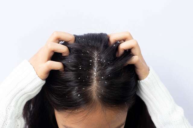 Shikakai for Hair: All The Benefits Plus Best Ways To Use 