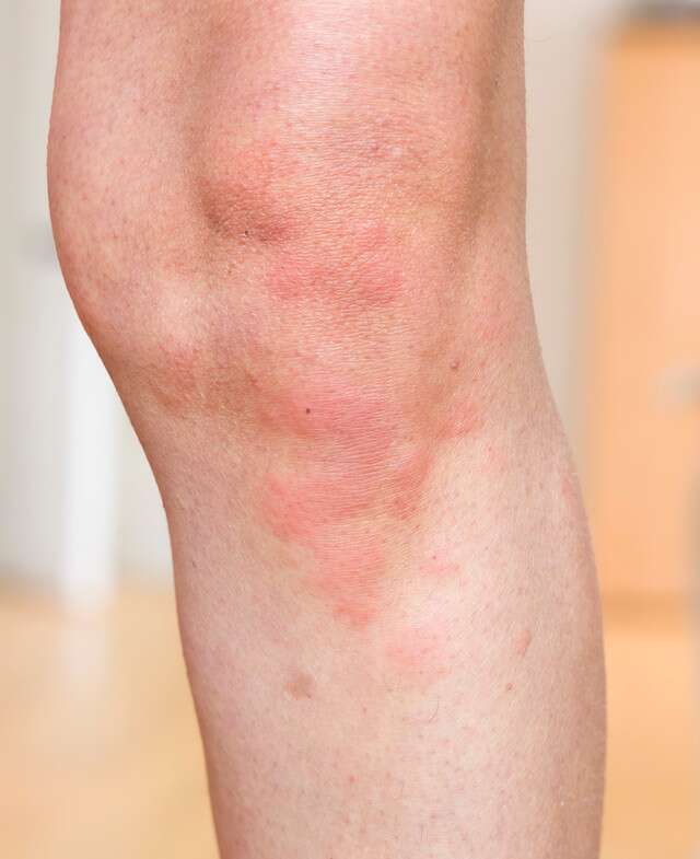 Upper Leg Redness, Causes & Treatments for Rash on Thighs