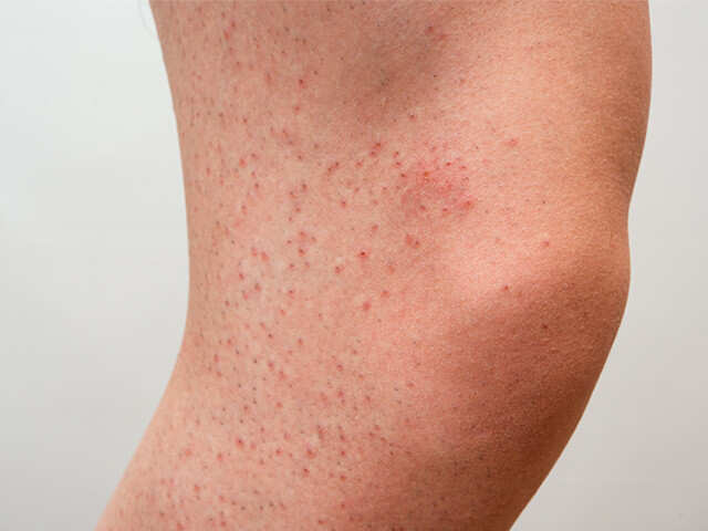 Upper Leg Redness, Causes & Treatments for Rash on Thighs