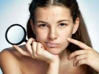 Pop These Myths Not Your Pimples