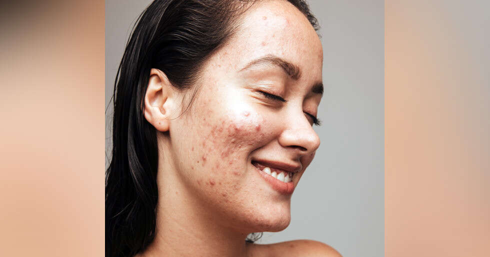 Team Femina Believes It Is Just A Pimple & Shares Tricks To Deal With Them - Vimarsana News