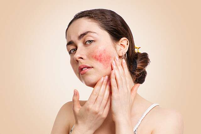 Skin Inflammation and Redness