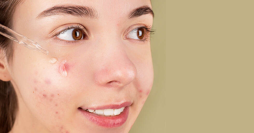 What's Azelaic Acid & Why Is It Touted As A Gentle Anti-acne Antidote - Vimarsana News