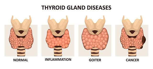 Understanding Thyroid Cancer And Its Link With Obesity | Femina.in