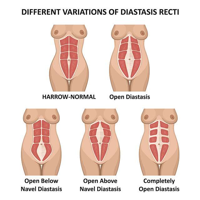 Visceral Fat and Diastasis Recti - StrengthSpace