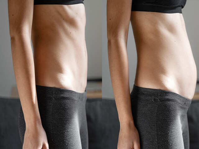 Diastasis Recti Abdominis (DRA)