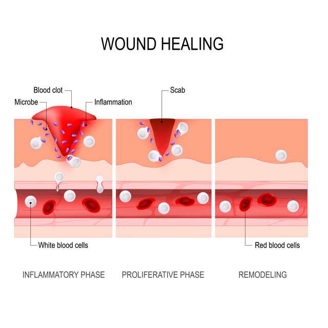 Inflammation Types: Wound Healing