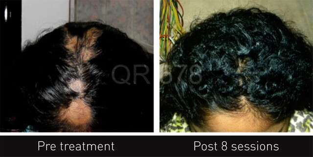 Hair Treatment Before After Results