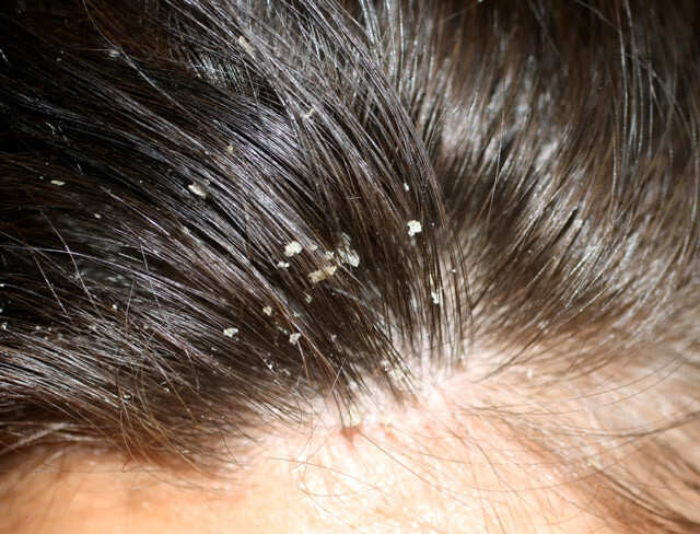 Reasons For Dandruff: Symptoms And Remedies To Get Rid Of It | Femina.in