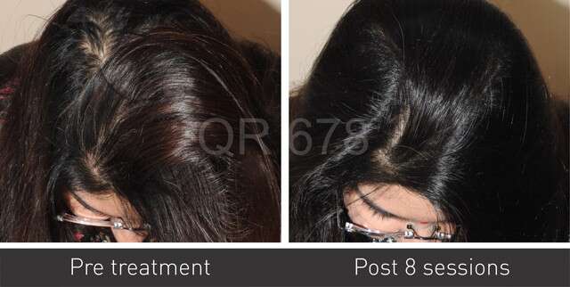 Hair Treatment Before After Results