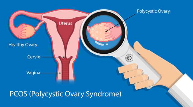 What Is PCOS?
