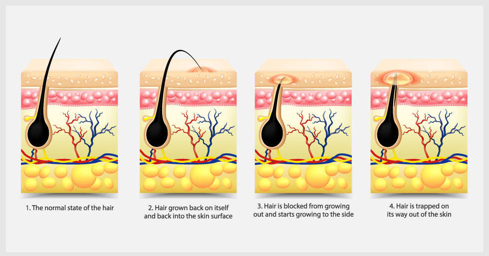 5 Ways To Get Rid Of Razor Bumps | Femina.in