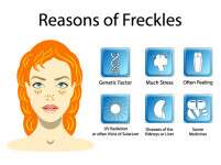 18 Ways On How To Get Rid Of Freckles
